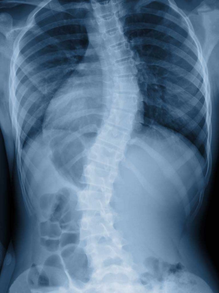 scoliosis treatment