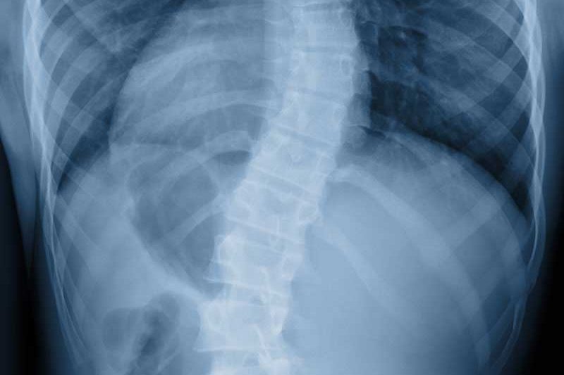 scoliosis treatment
